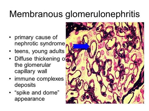 spike and dome|membranous glomerulonephritis causes.